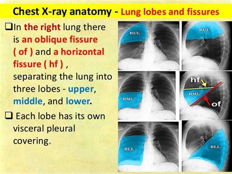 Chest X Ray Anatomy Lung Lobes And Fissures In The Right Lung There