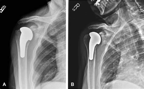 Radiographic Changes Differ Between Two Different Short Press Fit