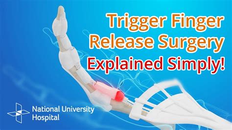 Trigger Finger Release Surgery Explained Youtube