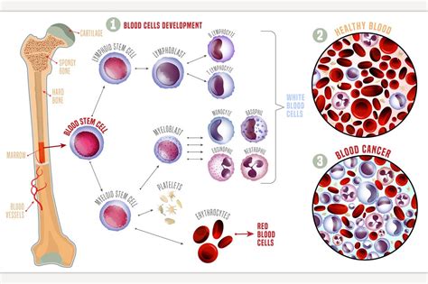 Leukemia Medical Infographic Healthcare Illustrations ~ Creative Market