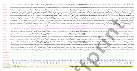 Video Eeg Polygraphic Recording In Case 1 Showing Interictal Atypical