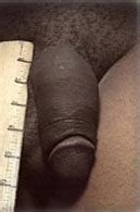 Augmentation et élargissement du pénis Penoplastie photo avant après