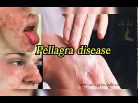 Learn more about the symptoms, causes, diagnosis, and treatment of carcinoid syndrome. PELLAGRA LEARN ABOUT #PHLF - YouTube