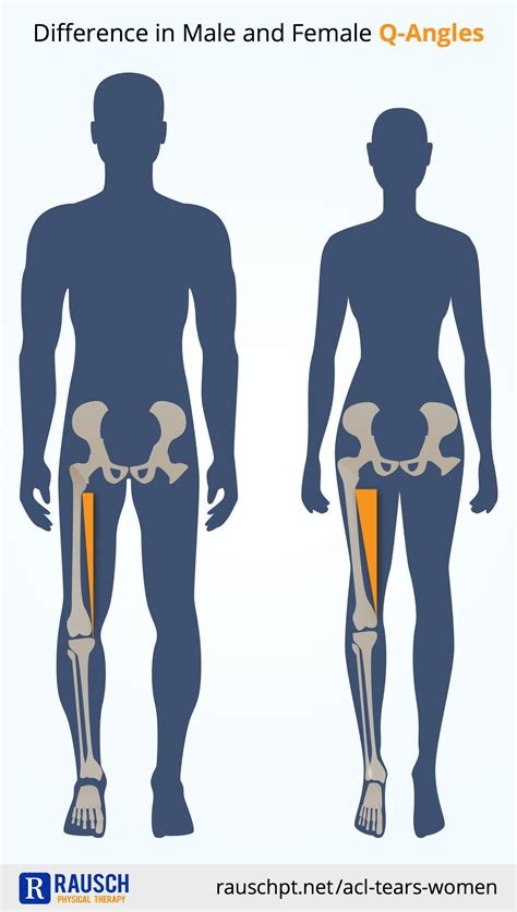Rausch Physical Therapy Sports Performance Why Your Babe Is More At Risk For An ACL Tear