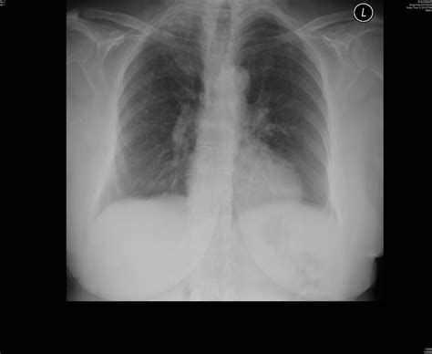 Apical Cap Chest X Ray Case 136 The Right Apex Is Opacifi Flickr