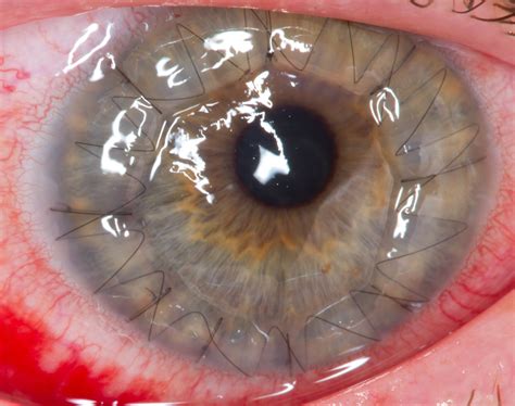 A Human Eye 1 Day After A Cornea Transplant Corneal Transplant