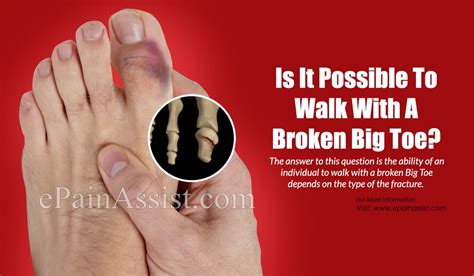 What Are The Symptoms Of A Broken Toe Broken Toe Self Care
