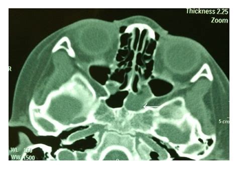 A And B Axial Ct Scans Showing Only Sphenoid Sinus With Soft Tissue