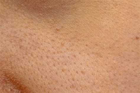 Enlarged Pores Dermacore