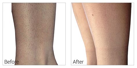 Laser hair removal near me prices. Laser Hair Removal Naperville Plainfield Bolingbrook ...