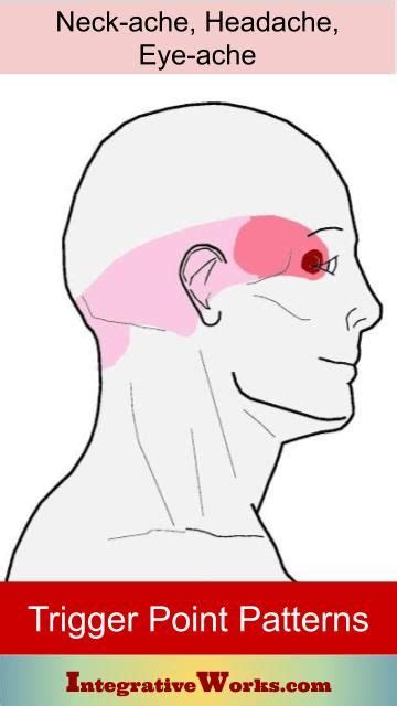 Trigger Points Neckche Headache Eyeache Integrative Works Trigger