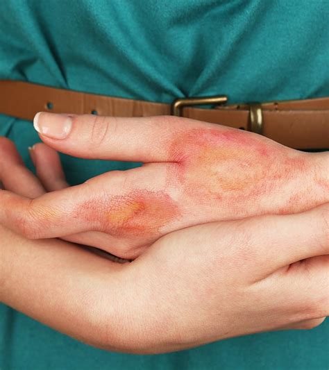 How To Treat Burns At Home 13 Natural Remedies To Try