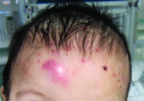A 7 Month Old Male Presents With Pustules And Inflamed Papules On The