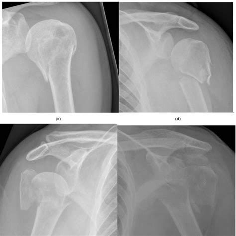 Proximal Humeral Fractures According To Neer Classification A One Part