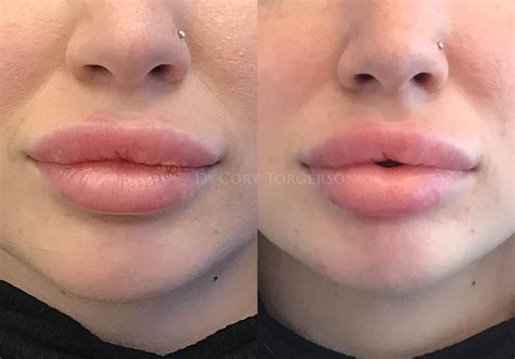 botox injections in lips before and after