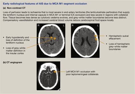 Stroke In The Acute Setting Medicine