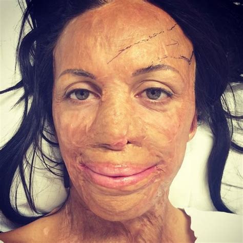 Turia Pitt Surgery And Procedures To Continue For Years