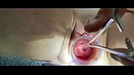 Insemination With Sperm Injection Into Cervix Xnxx Com