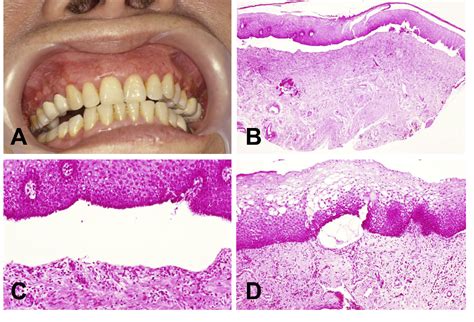 Figure 1 From Cicatricial Pemphigoid Presenting As Desquamative