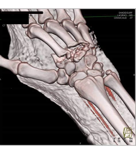 Iliac Wing Fracture Extend Into The Acetabulum - Trauma ...