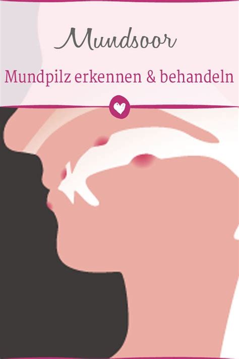 Bei soor im mund erfolgt die behandlung meist örtlich mit mundspüllösungen, lutschtabletten, oder gelen und suspensionen zum auftragen. Mundsoor: Mundpilz erkennen und behandeln | Pilze ...