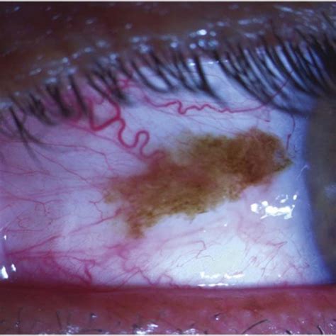 Cilio Choroidal Malignant Melanoma Extending To The Ciliary Body And