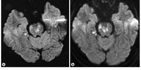 Diffusion Weighted Magnetic Resonance Image Showing Punctate Diffusion