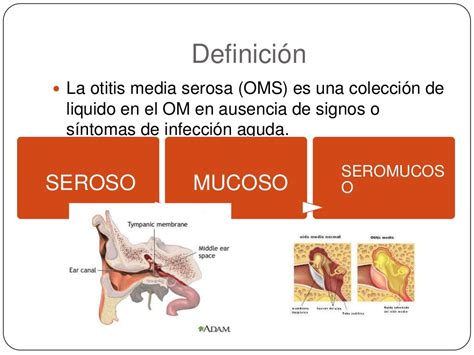 Cid Otite Media Serosa