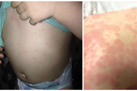 Terrified Mums Warning About Sons Rash That Could Have Proved Deadly