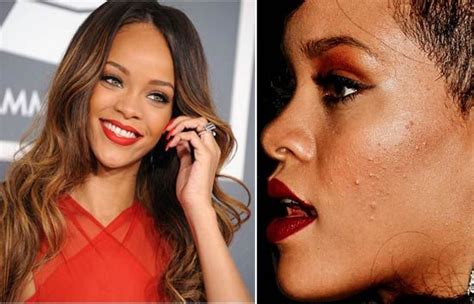 Rihanna Celebs With Acne Zits Pimples Celebrity Skin Hollywood