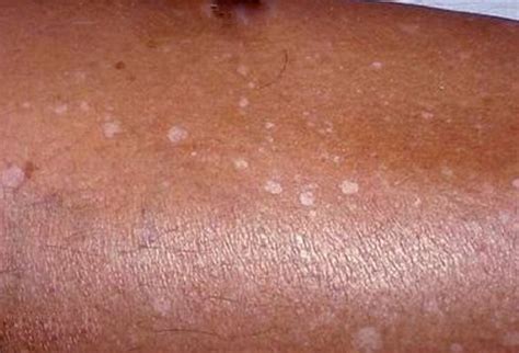 Tiny White Spots On Skin Causes Printable Templates