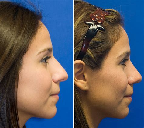 Long Over Projected Nose Rhinoplasty In Seattle Rhinoplasty Surgeon