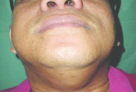 Submental Swelling In The Patient Thought To Be A Ranula Download