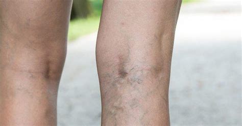 Are Varicose Veins More Than A Cosmetic Concern Premier Vein Clinic