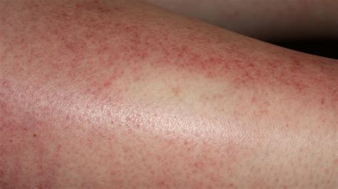 Sun Poisoning Symptoms Causes Treatment And More