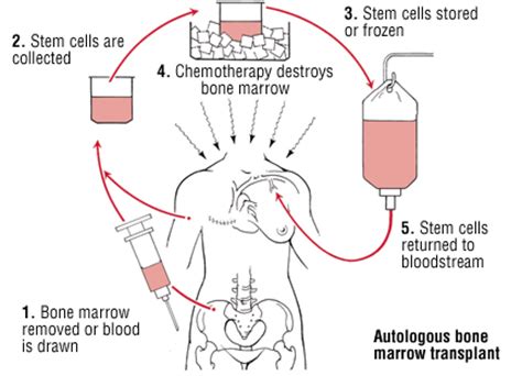 Usually it forms in the white. Bone marrow (stem cell) transplantation. Causes, symptoms ...