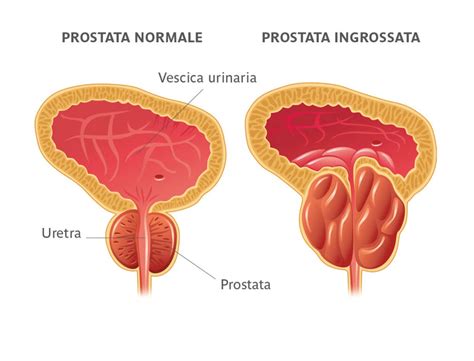 Prostata Ingrossata