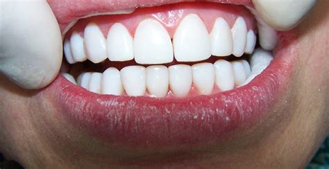 diseno de sonrisa clinica dental sonrisalud