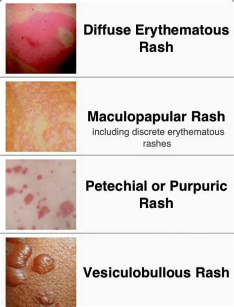 Skin Rash Identification Chart Adults