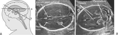 ULTRASOUND EVALUATION OF THE FETAL NEURAL AXIS | Radiology Key