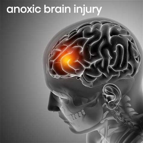 Severe Anoxic Brain Injury Hyperbaric Oxygen Therapy Hbot Clinic In