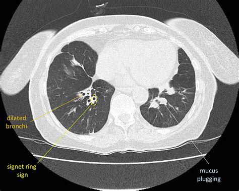 Chest Pathology Radiology Cafe