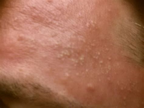 Small Red Bumps On Face Pictures Photos