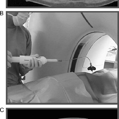 Interventional Procedure Of Percutaneous Vertebroplasty A Insertion