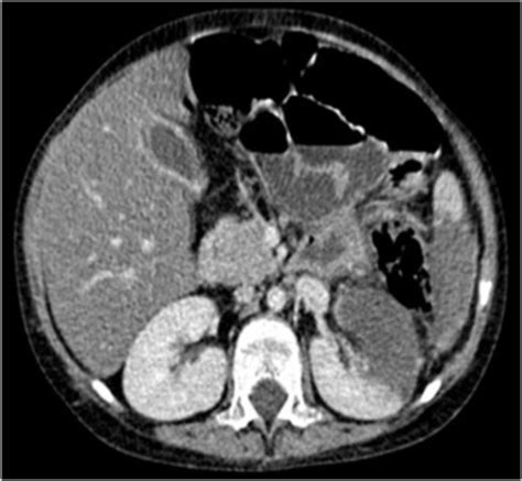 Ct Scan Showed Colonic Mural Thickening In The Splenic