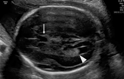 Axial View Of The Fetal Head In The Transventricular Plane Showing The
