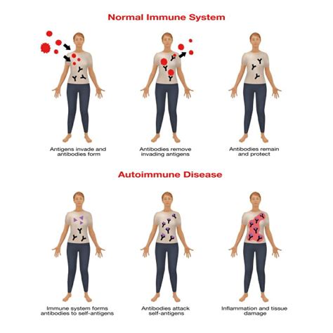 Posterazzi Normal Immune System And Autoimmune Disease Poster Print By