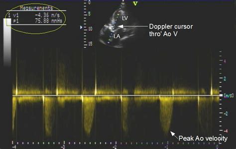 Continuous Wave Cw Doppler Imaging In Aortic Stenosis All About