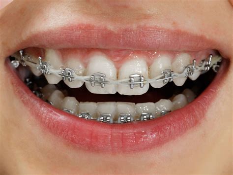 The Benefits And Drawbacks Of Clear Braces That You Need To Understand
