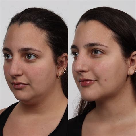 Patient 100876850 Deep Neck Lift Before And After Photos Peak Plastic